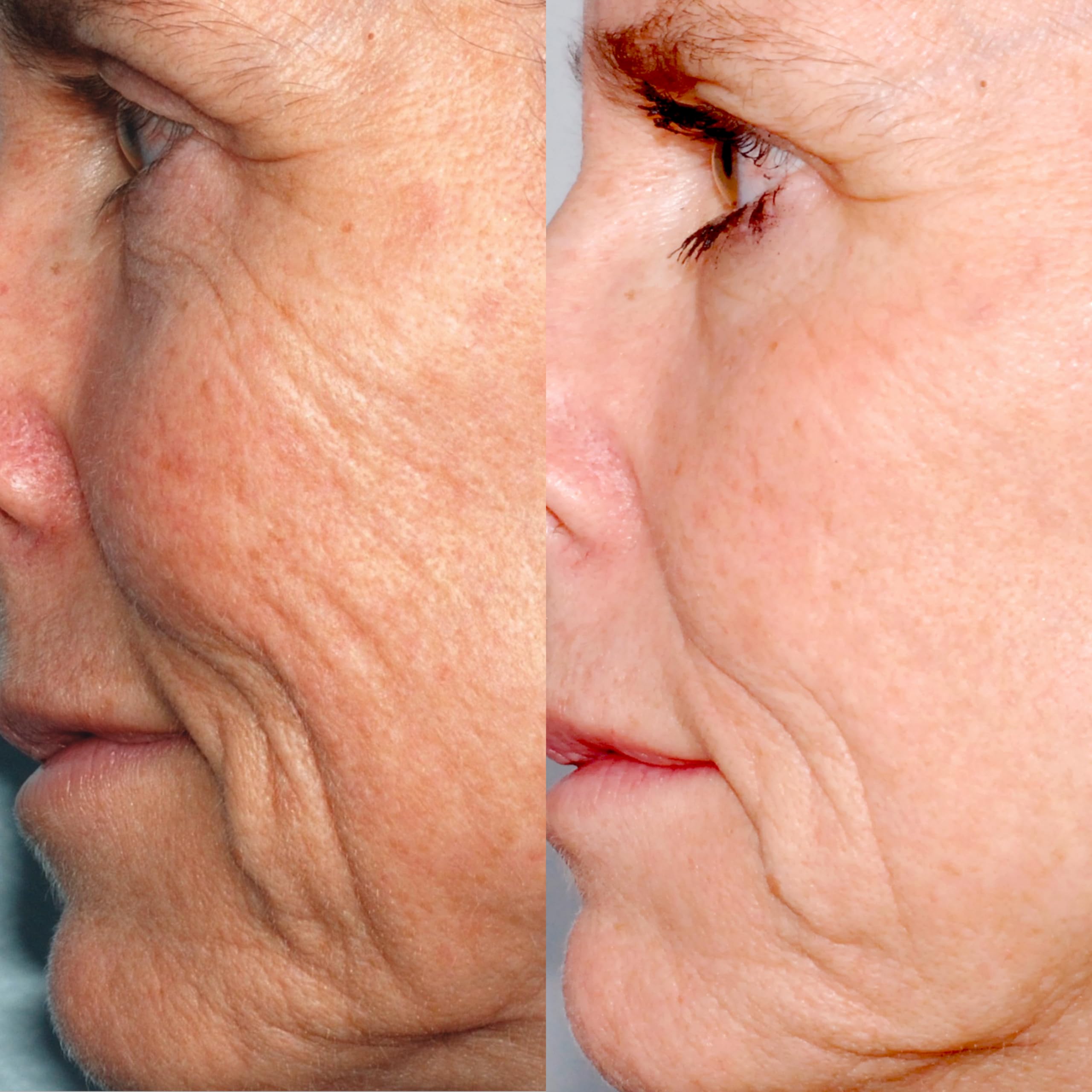 PMD Personal Microderm System, Teal